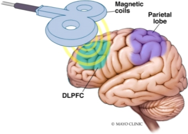 TMS Coil stimulate the DLPFC